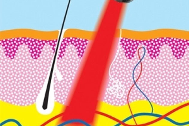 Лазерное воздействие на кожу skinlift ru. Лазерное излучение на кожу. Низкоинтенсивный лазер. Низкоинтенсивная лазерная терапия.